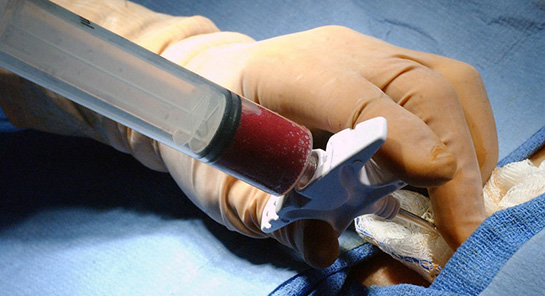 Kemik İliği Kanseri Belirtileri ve Tedavisi