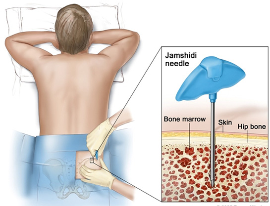Kemik İliği Testi Nedir ve Nasıl Yapılır?